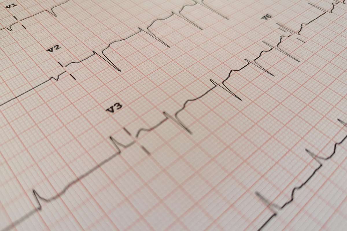 Atrial Fibrillation: Symptoms, Risks, and What to Do